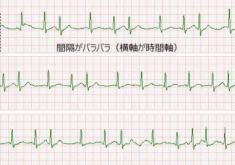 心房細動とは？ | くま次郎日記